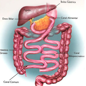 Desvio bilio pancreático (Scopinaro)